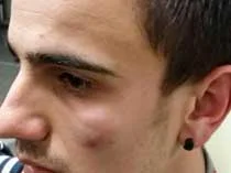 Attivista 5 Stelle preso a pugni dai piddini